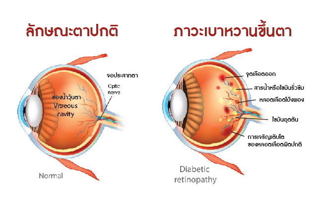 เบาหวานขึ้นตา – โรงพยาบาลบางโพ