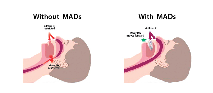 ภาพตัวอย่างทันตอุปกรณ์ยื่นขากรรไกรล่าง (MAD) ที่ช่วยในการรักษานอนกรน (OSA)